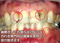 プロフェッショナル・メカニカル・ティース・クリーニング