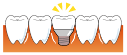 インプラント治療法