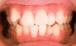 インビザライン・システム治療例1　術前